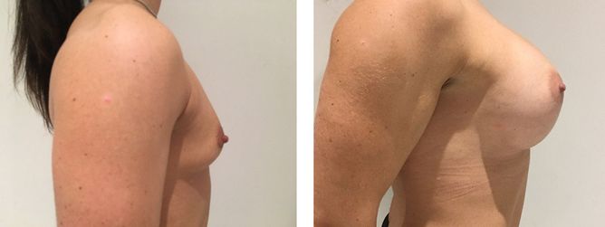 30 Year Old Female - Breast Augmentation