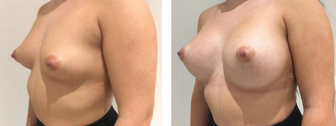 24 Year Old Female - Breast Augmentation