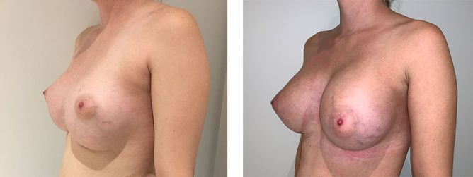 28 Year Old Female - Breast Revision - bodybyZ