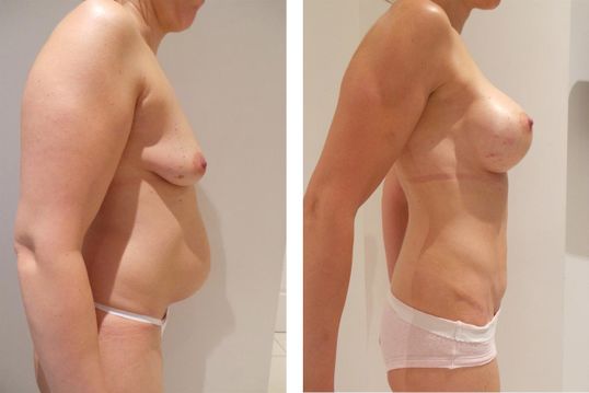 40 Year Old Female - TABA - bodybyZ