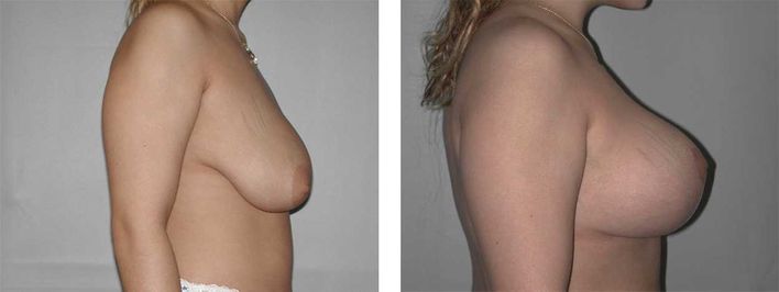 21 Year Old Female - Breast Lift - bodybyZ