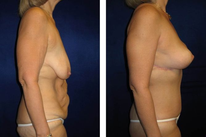 Major Weight Loss Surgery - bodybyZ