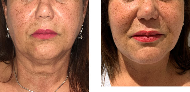 59 Year Old Female - Face Lift