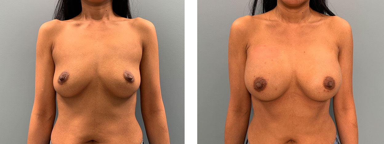 38 Year Old Female - Breast Augmentation