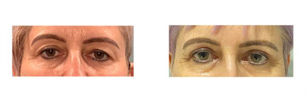 Upper Eyelid Surgery