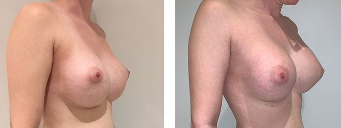 28 Year Old Female - Breast Revision - bodybyZ