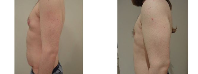 27 Year Old Male - Tummy Tuck Surgery