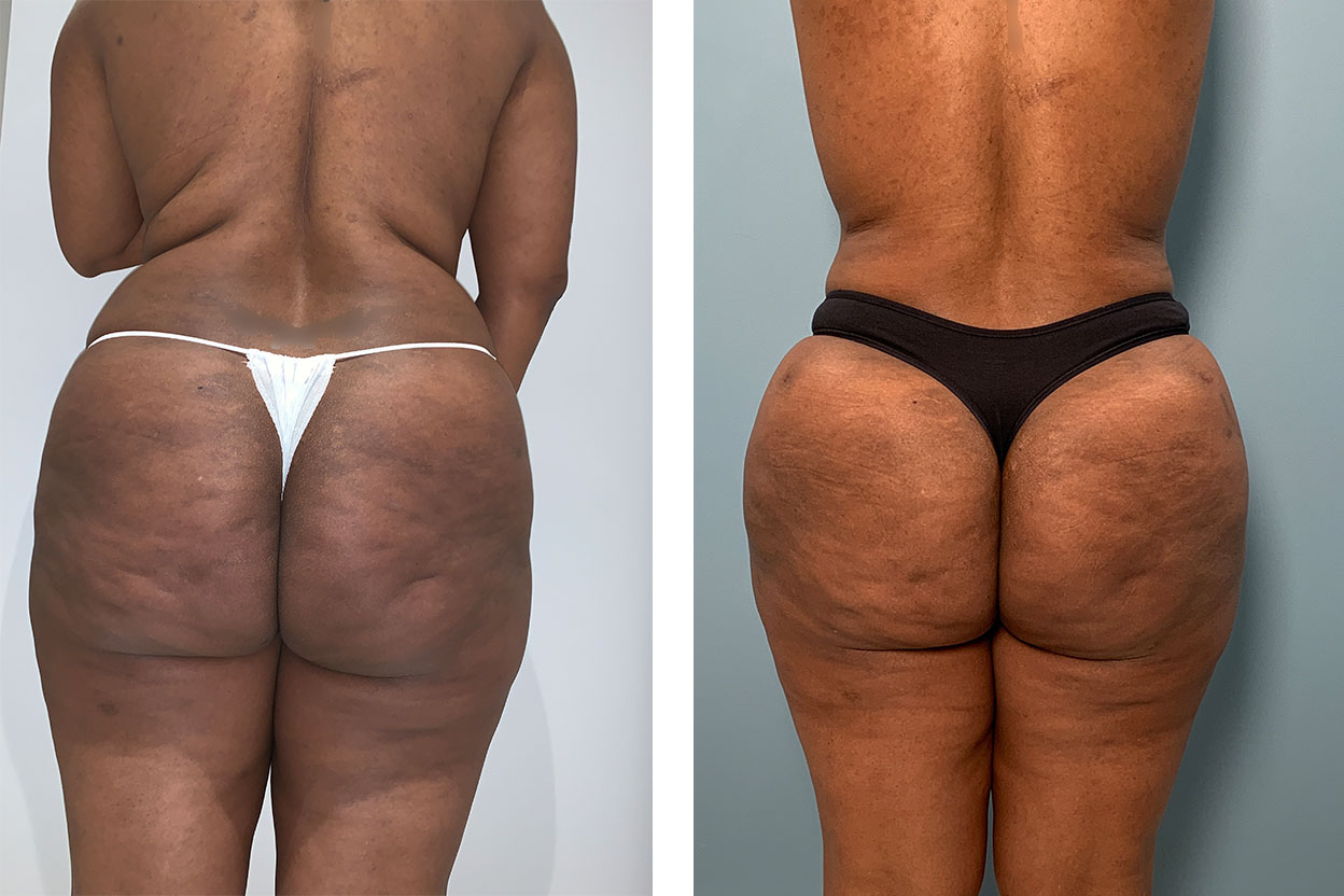 37 Year Old Female - Brazilian Butt Lift - bodybyZ