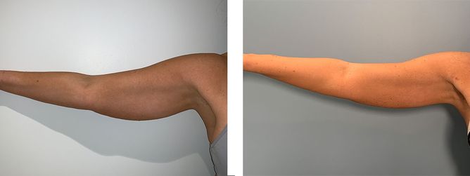 40 Year Old Female - Liposuction - bodybyZ