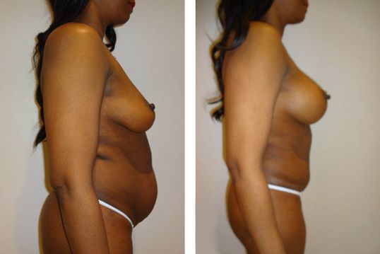 44 Year Old Female - TABA - bodybyZ