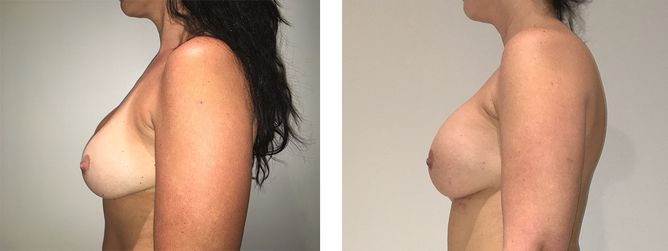 40 Year Old Female - Breast Revision - bodybyZ