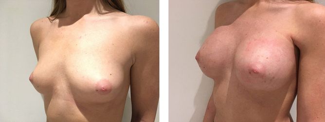 26 Year Old Female - Breast Augmentation