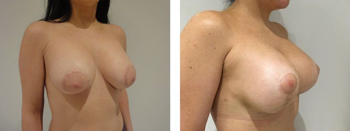 36 Year Old Female - Breast Lift - bodybyZ