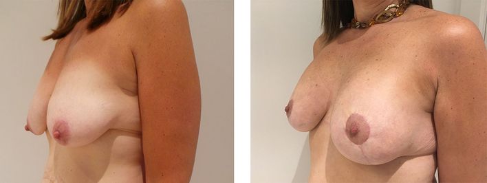 43 Year Old Female - Breast Lift - bodybyZ