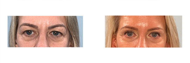 Eyelid and Face lift