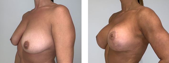 41 Year Old Female - Breast Lift - bodybyZ