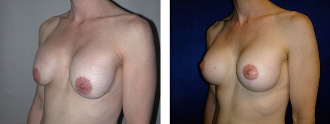 42 Year Old Female - Breast Revision - bodybyZ
