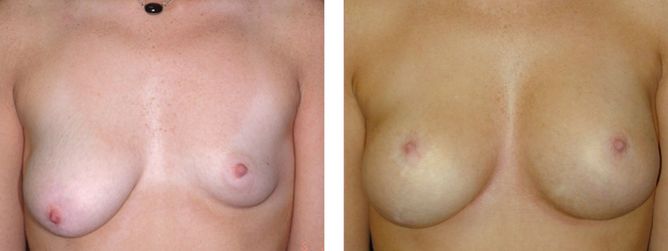 Breast Revision - bodybyZ