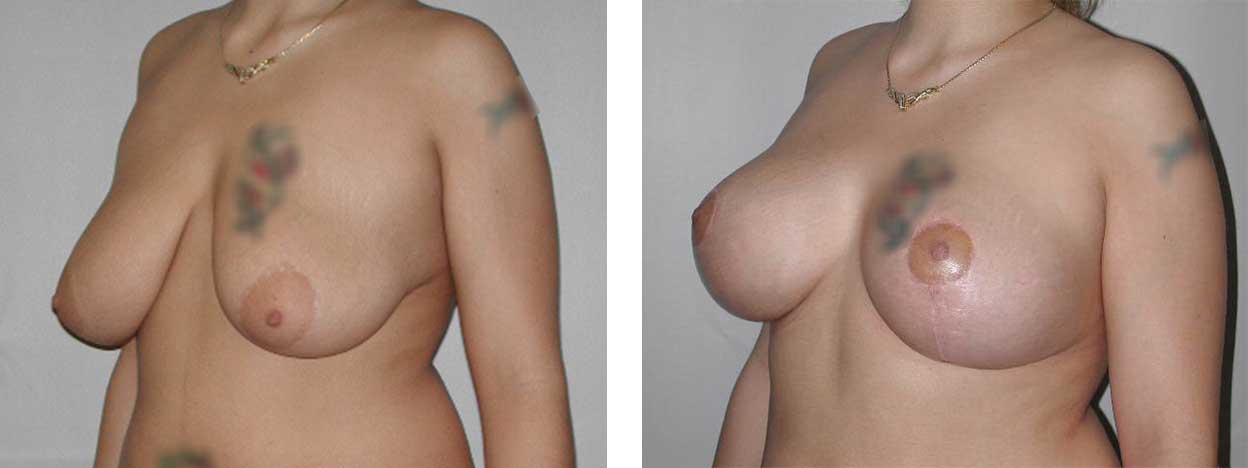 21 Year Old Female - Breast Lift - bodybyZ