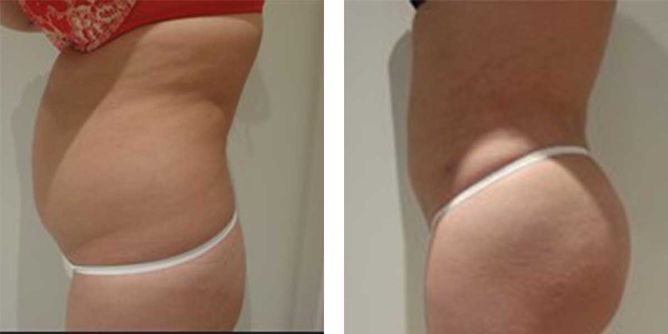 26 Year Old Female - Liposuction - bodybyZ