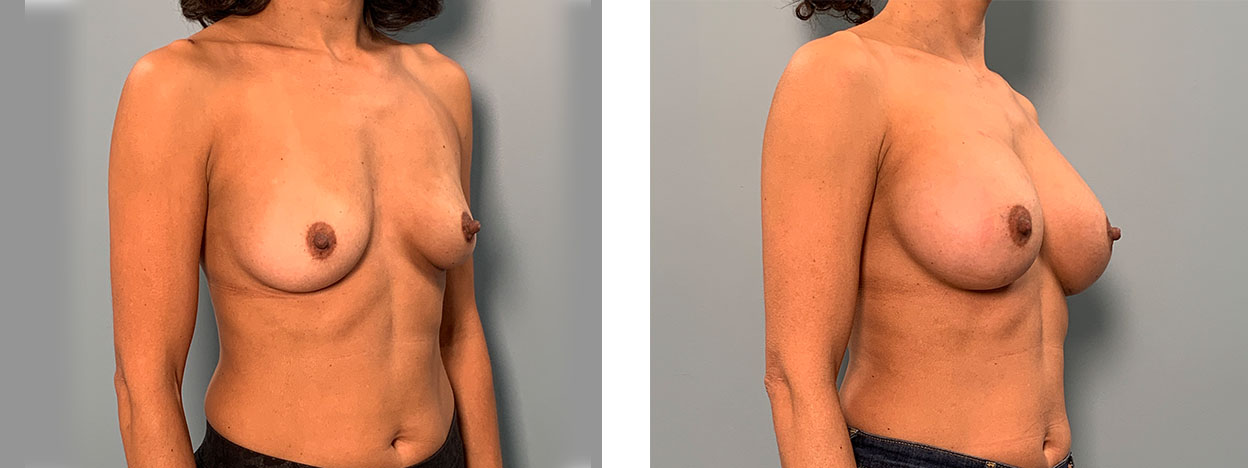 Transaxillary Breast Augmentation - no scarring