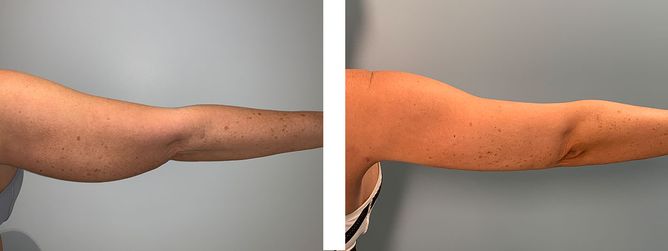 40 Year Old Female - Liposuction - bodybyZ