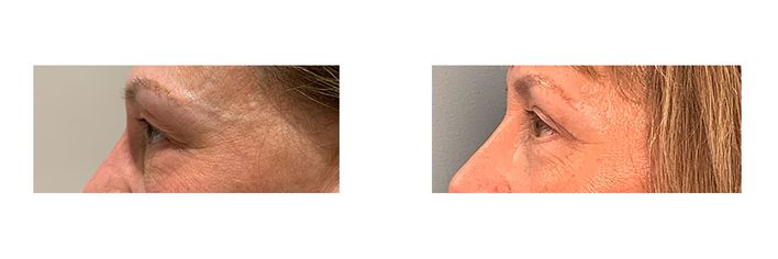 55 Year Old Female - Eyelid Surgery - bodybyZ