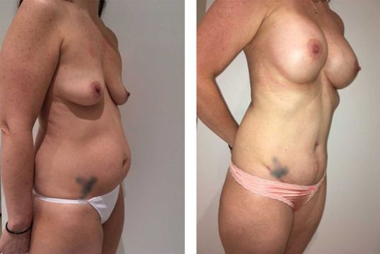 36 Year Old Female - TABA - bodybyZ