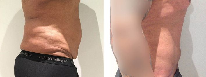 40 Year Old Male - Tummy Tuck Surgery