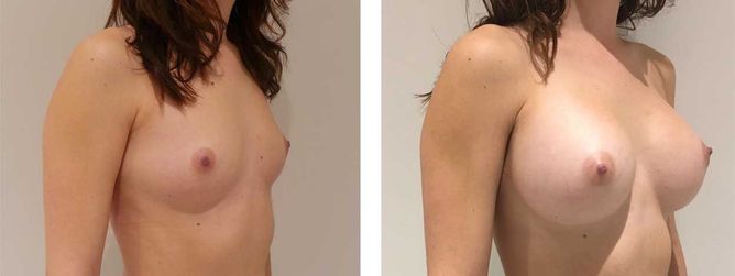 28 Year Old Female - Breast Augmentation