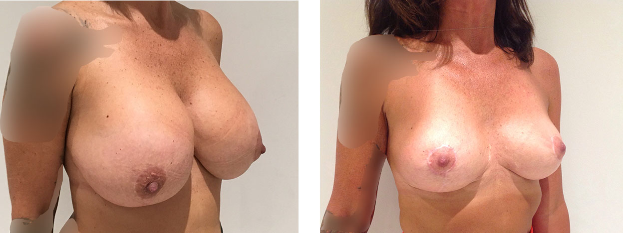 43 Year Old Female - Breast Revision - bodybyZ