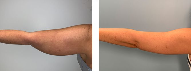 40 Year Old Female - Liposuction - bodybyZ