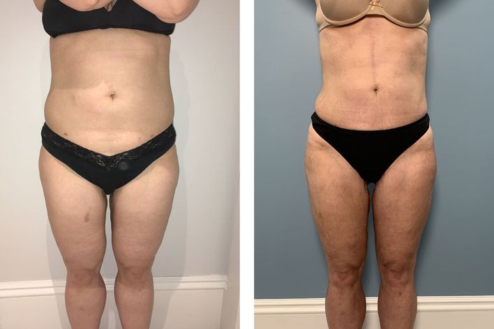 45 Year Old Female - Liposuction - bodybyZ