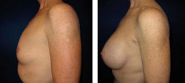 40 Year Old Female - Breast Augmentation