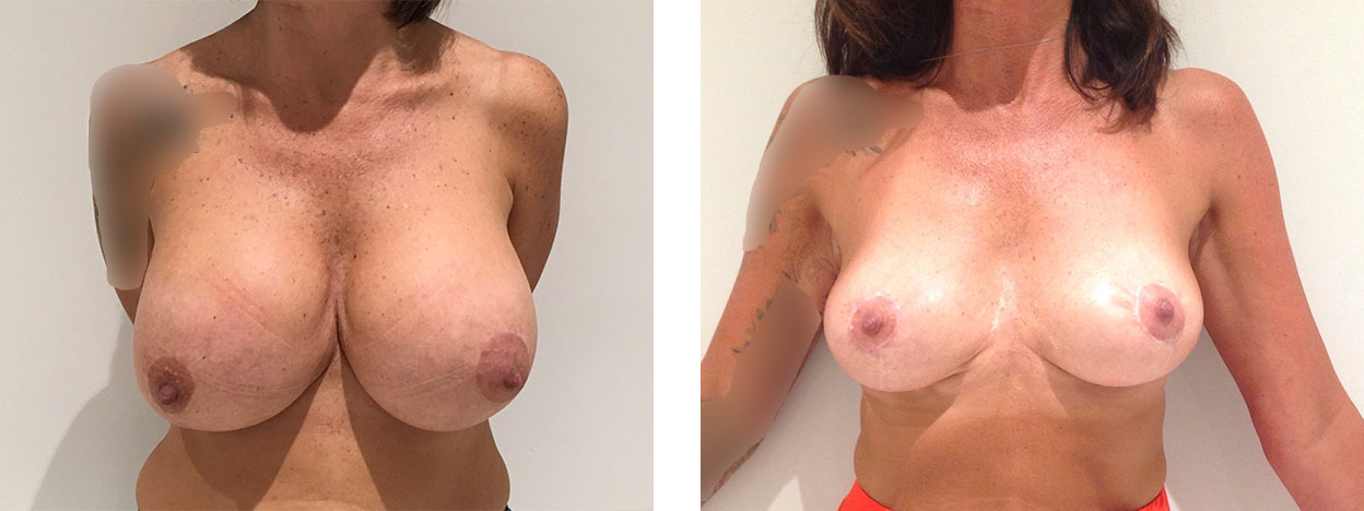 43 Year Old Female - Breast Revision - bodybyZ