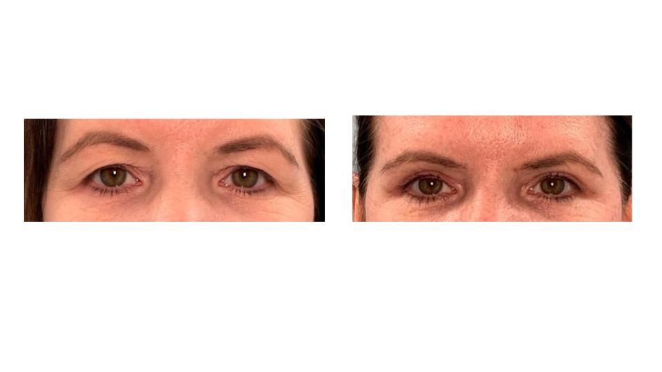 Eyelid Lift Surgery Cranston