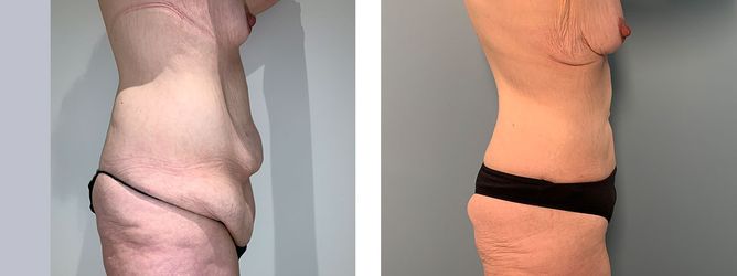 36 Year Old Female - Major Weight Loss Surgery - bodybyZ