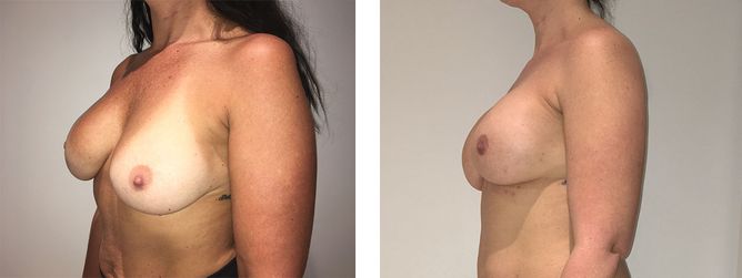 40 Year Old Female - Breast Revision - bodybyZ