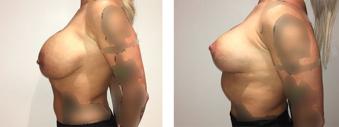 36 Year Old Female - Breast Revision - bodybyZ