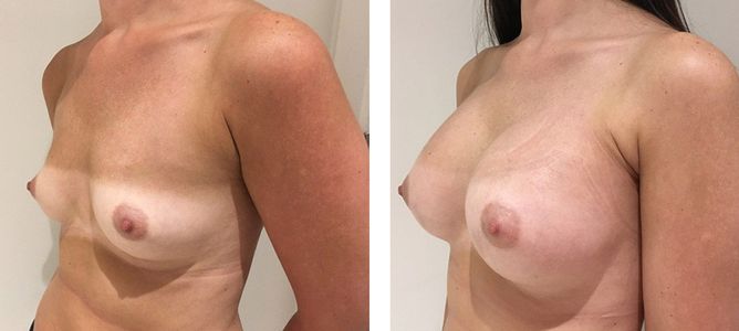 30 Year Old Female - Breast Augmentation