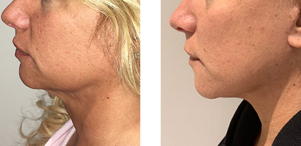 47 Year Old Female - Face Lift 