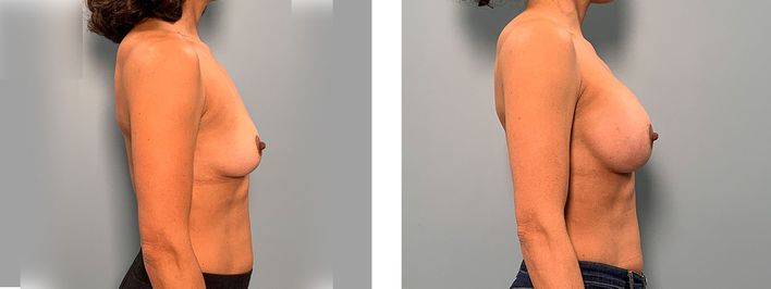 Transaxillary Breast Augmentation - Providence, RI