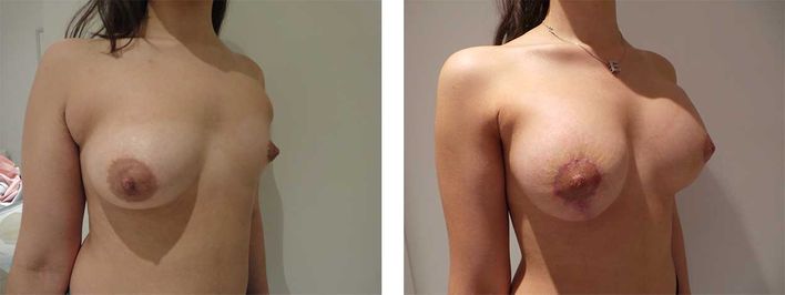 20 Year Old Female - Breast Lift - bodybyZ