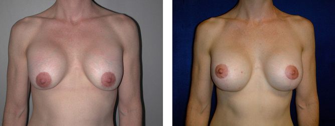 42 Year Old Female - Breast Revision - bodybyZ