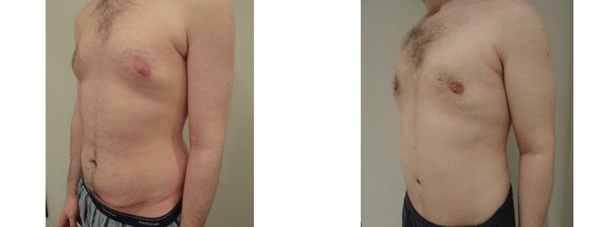27 Year Old Male - Tummy Tuck Surgery