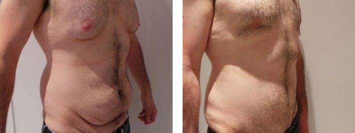 19 Year Old Male - Tummy Tuck Surgery