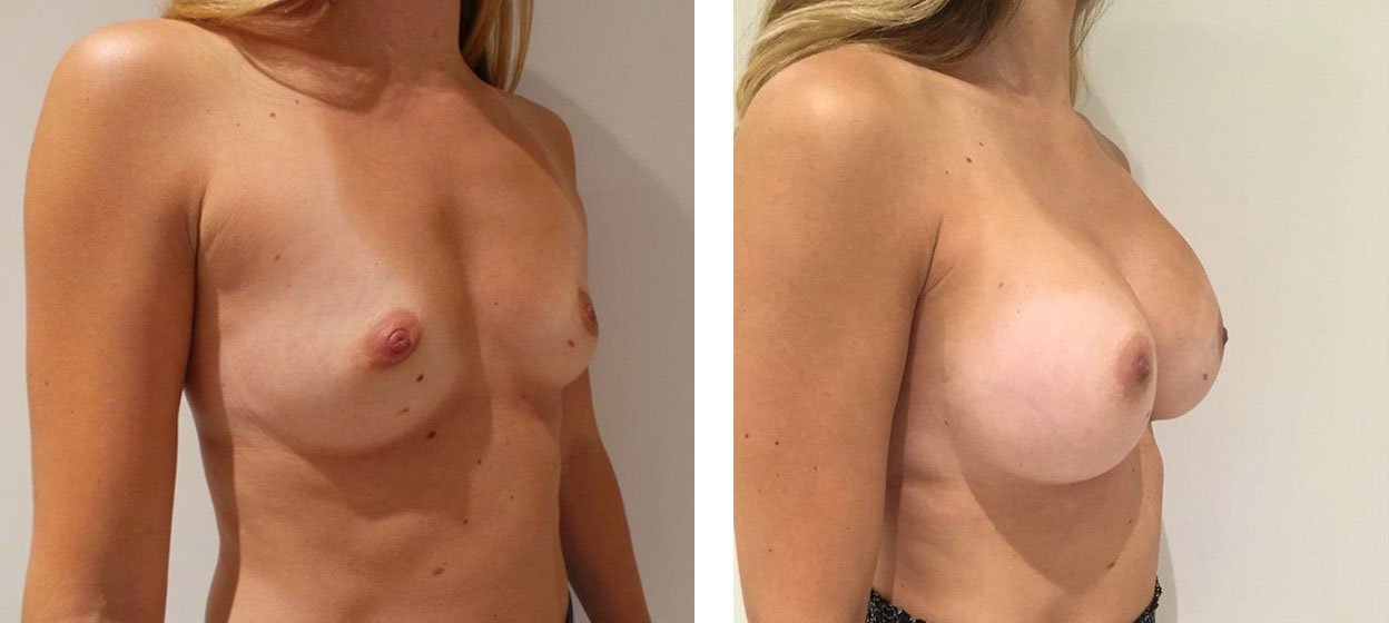 31 Year Old Female - Breast Augmentation