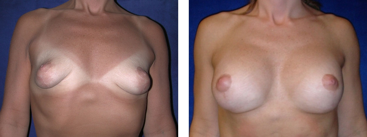 40 Year Old Female - Breast Revision - bodybyZ
