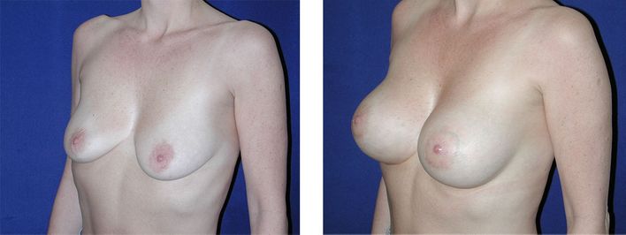 49 Year Old Female - Breast Lift - bodybyZ