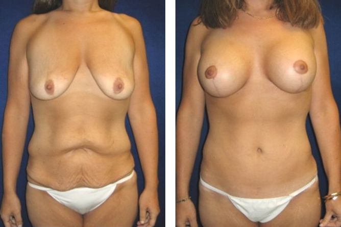 Major Weight Loss Surgery - bodybyZ